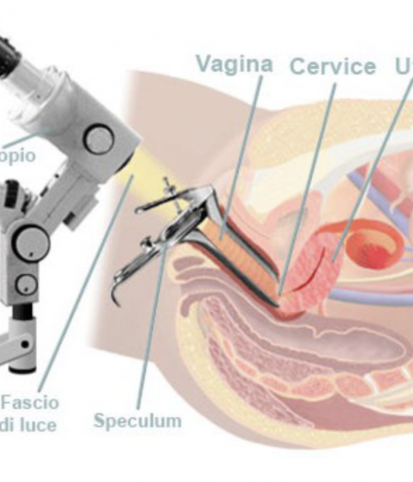 colposcopia-computerizzata